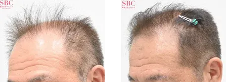 湘南AGAクリニック 広島院の症例写真