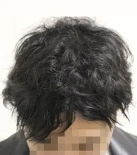 AGAスキンクリニック 広島院の症例写真6ヶ月後