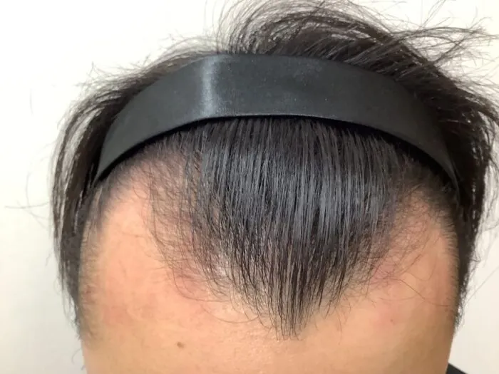 駅前AGAクリニック 広島院の症例写真治療前
