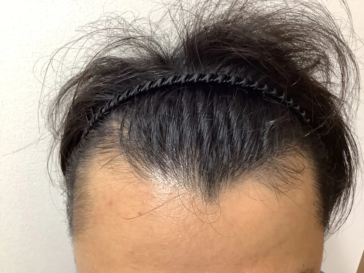 駅前AGAクリニック 広島院の症例写真5ヶ月後