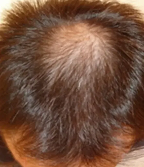 ゴリラクリニック 広島院の症例写真治療前