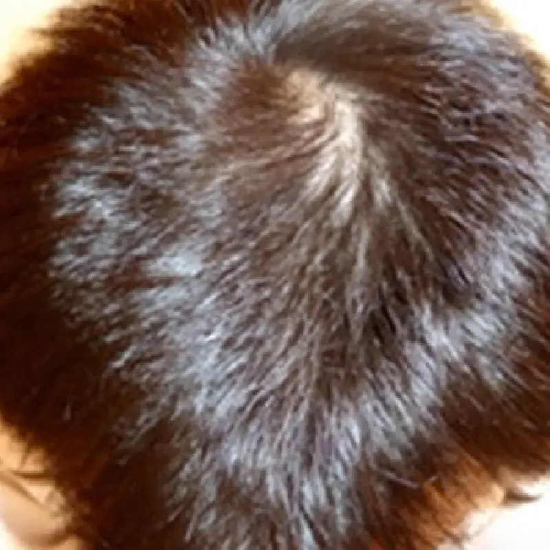 ゴリラクリニック 広島院の症例写真4ヶ月後