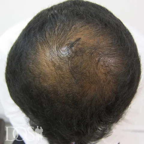 男たちの美容外科 広島院の症例写真治療前