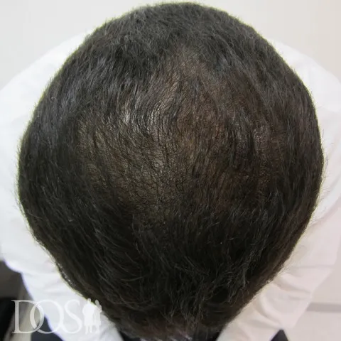 男たちの美容外科 広島院の症例写真6ヶ月後