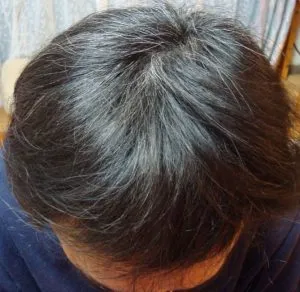 広島プルミエクリニックの症例写真8ヶ月後