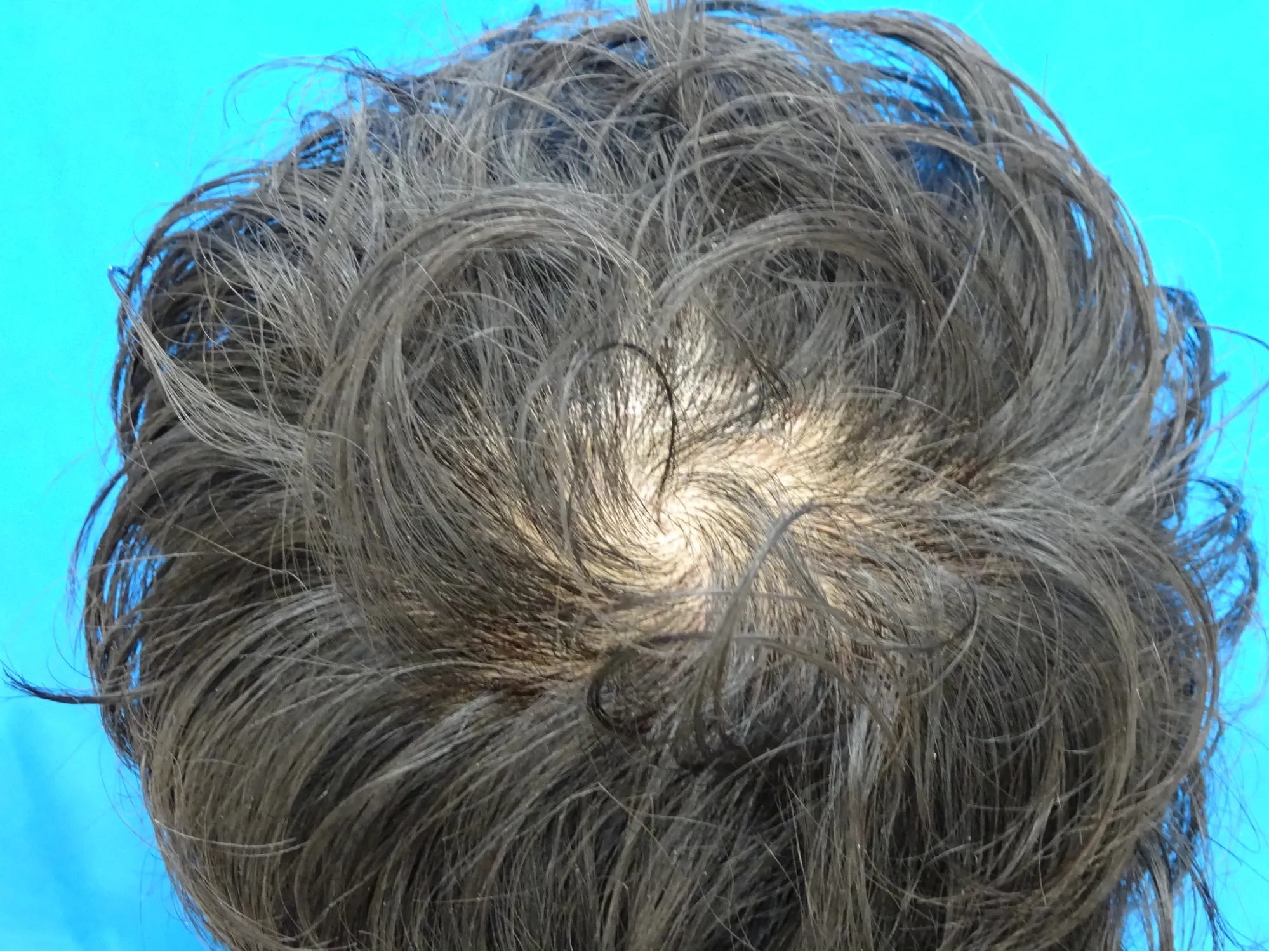 TCB東京中央美容外科 広島院・福山院の症例写真治療前