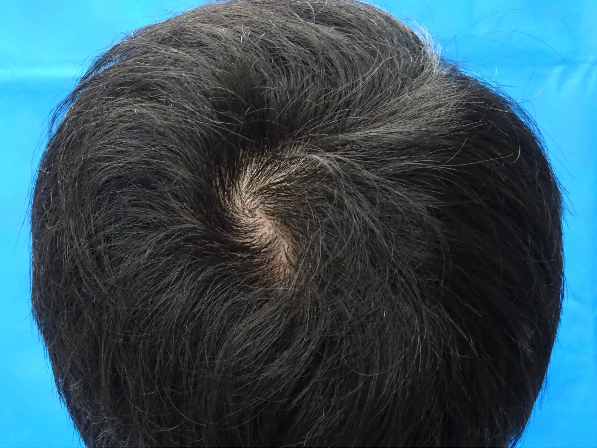 TCB東京中央美容外科 広島院・福山院の症例写真12ヶ月後