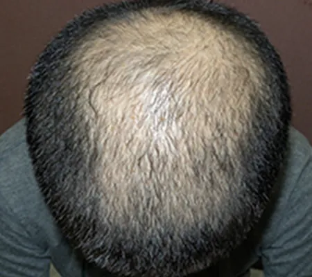 Oops HAIRの症例写真治療前