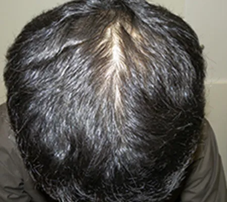 Oops HAIRの症例写真12ヶ月後