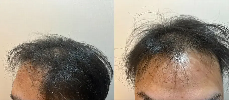 レバクリの症例写真治療前