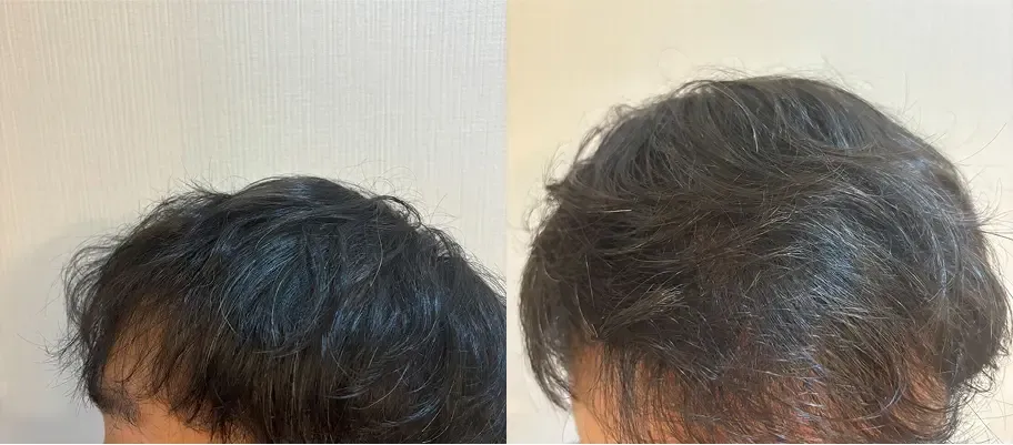 レバクリの症例写真4ヶ月後