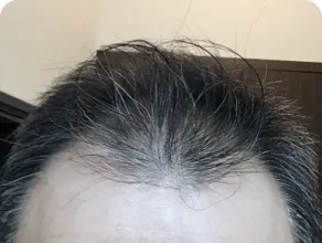 AGAスマクリの症例写真治療前