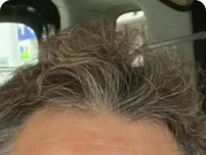 AGAスマクリの症例写真4ヶ月後