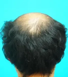 AGAスキンクリニックの症例写真治療前