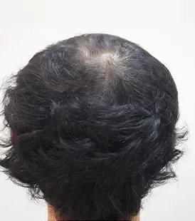 AGAスキンクリニックの症例写真7ヶ月後