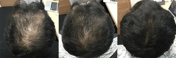 AGAヘアクリニックの症例写真