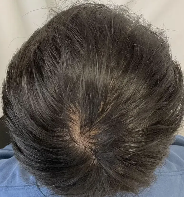 湘南AGAクリニックの症例写真治療前