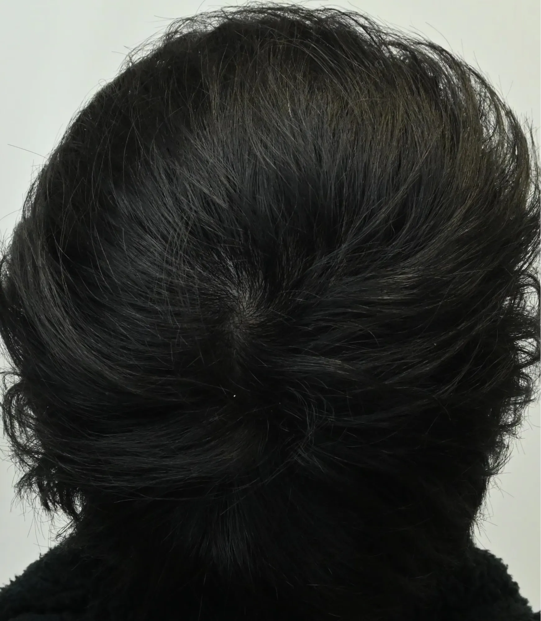 湘南AGAクリニックの症例写真3ヶ月後