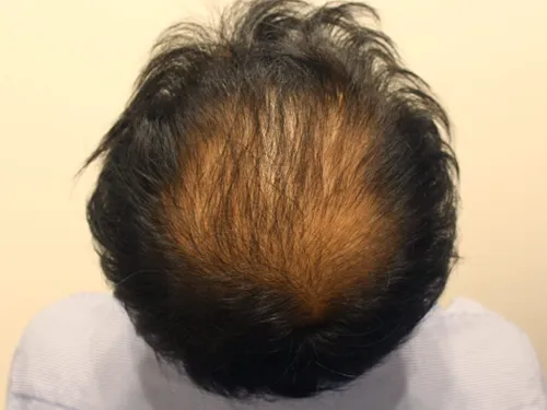 銀座総合美容クリニックの症例写真治療前