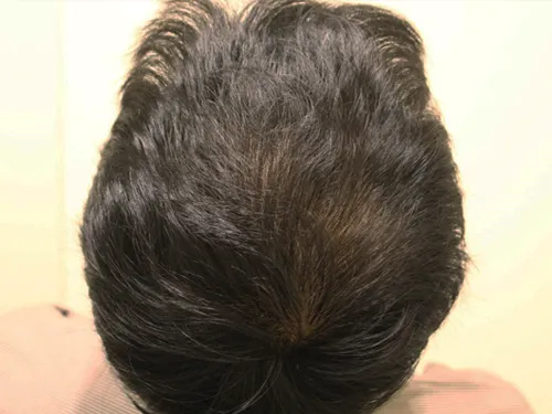 銀座総合美容クリニックの症例写真6ヶ月後