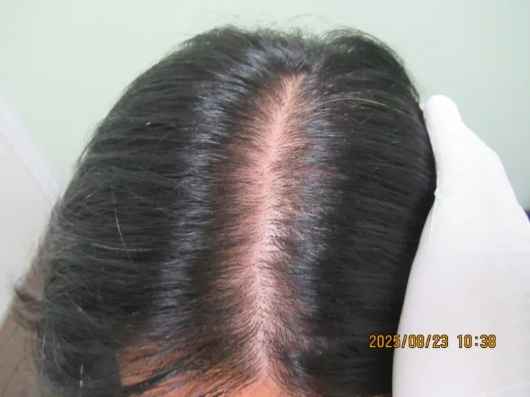 おもろまちヘア美容Clinicの症例写真6ヶ月後