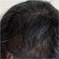 AGA薄毛予防治療クリニックの症例写真6ヶ月後