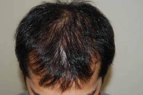 ひろ耳鼻科皮膚科形成外科の症例写真治療前