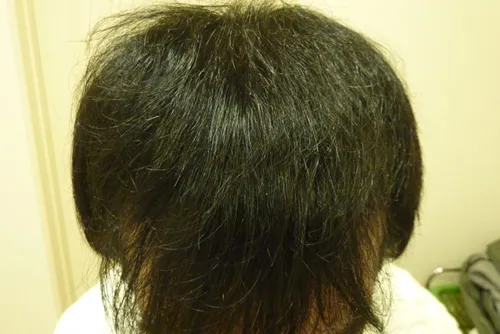 ひろ耳鼻科皮膚科形成外科の症例写真1年3ヶ月後