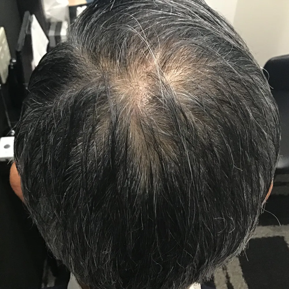 ウィルAGAクリニック 仙台院の症例写真8ヶ月後