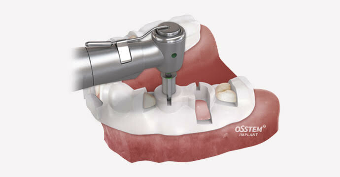 インプラントの施術イメージ