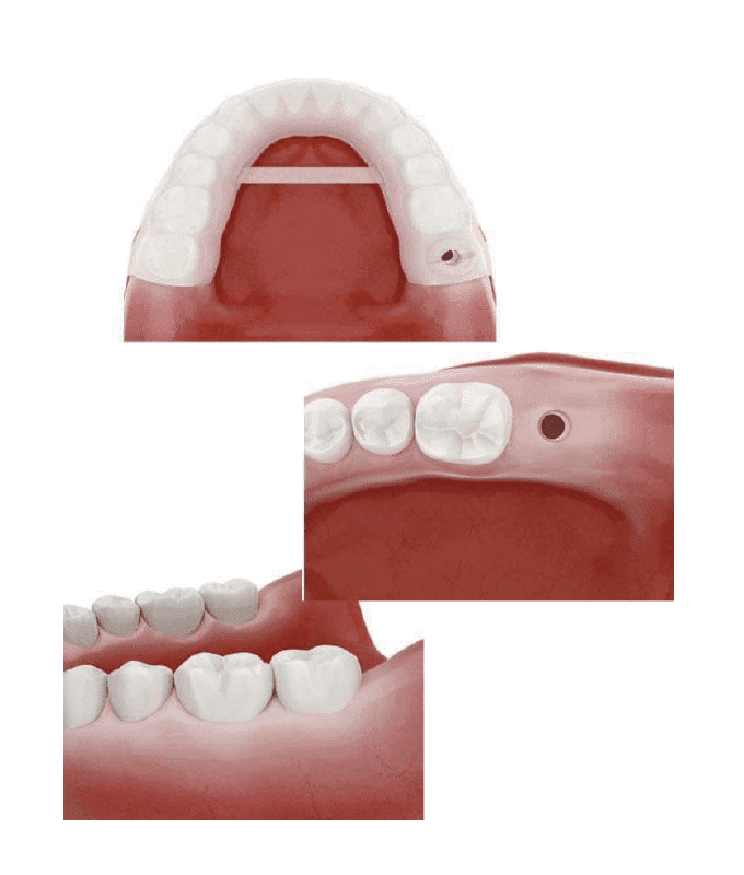 インプラント施術のイメージ画