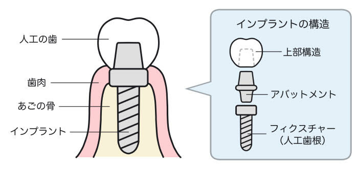 インプラントの構造